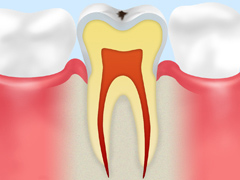 むし歯の進行と治療法