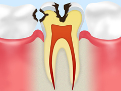 象牙質のむし歯（C2）