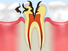 神経に達したむし歯（C3）