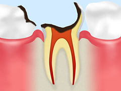 歯根に達したむし歯（C4）