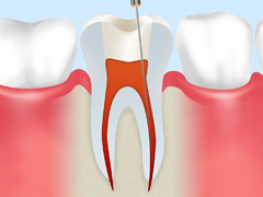 根管治療