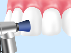 歯面清掃