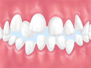歯並びや噛み合わせが悪化！