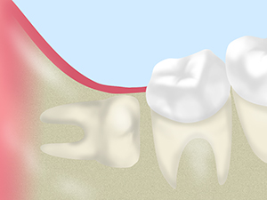 親知らずなどの抜歯